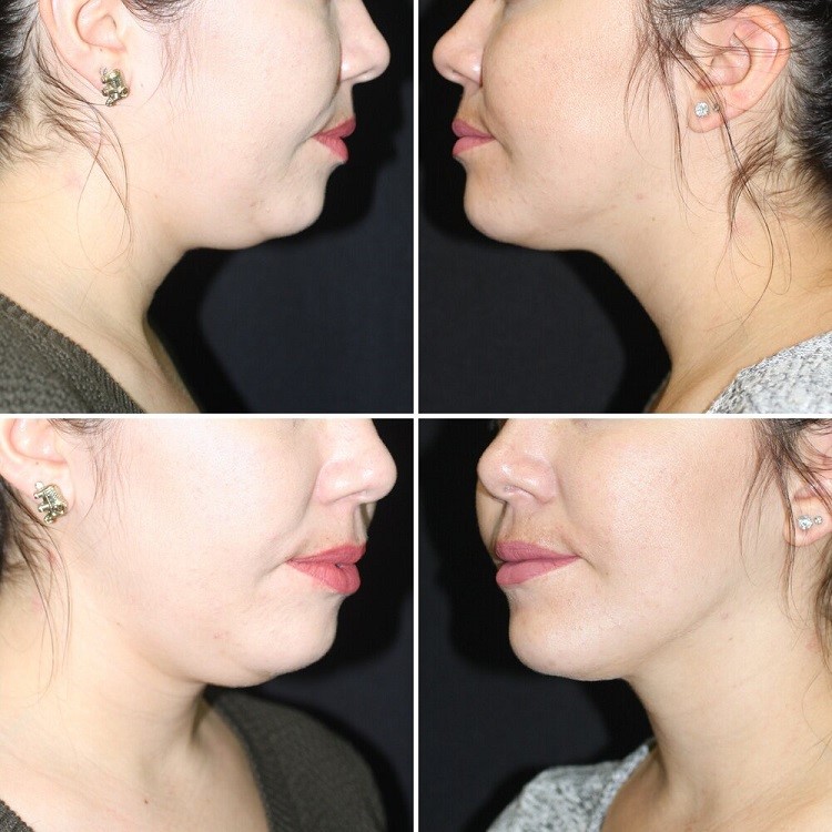 Chin Sculpting Techniques: Which One is Right for You?